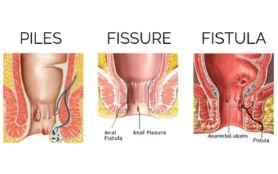 Piles Fissure Fistula Clinic