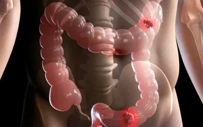 Irritable_Bowel_Syndrome_(IBS)