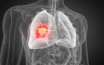 Peptic_Ulcer_Disease