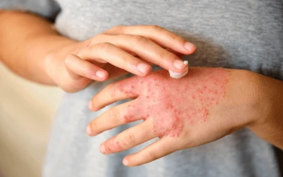 Skin Disorders