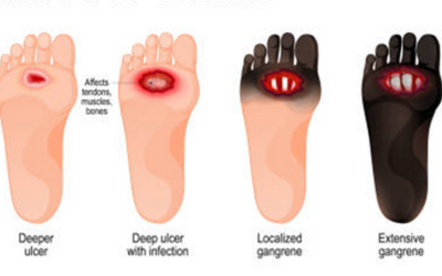 Charcot Foot - Doctor Galaxy Diabetes__Blood_Sugar_Disorders
