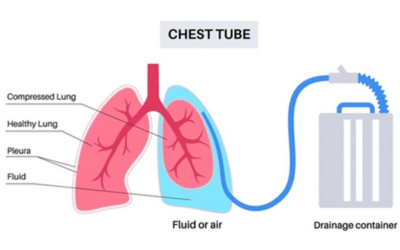 Chest Tube Insertion Rib Fixation - Doctor Galaxy