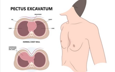 Chest Wall Deformities - Doctor Galaxy