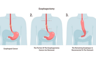 Esophagectomy - Doctor Galaxy