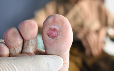 Foot Ulcers - Doctor Galaxy Diabetes__Blood_Sugar_Disorders