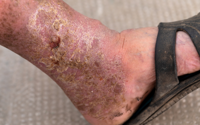 Gangrene - Doctor Galaxy Diabetes__Blood_Sugar_Disorders