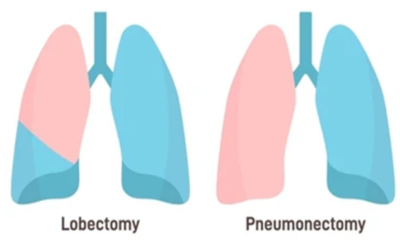 Lobectomy Pneumonectomy - Doctor Galaxy