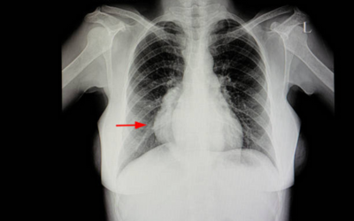Mediastinal Tumors - Doctor Galaxy