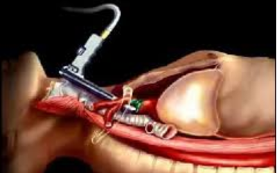 Mediastinoscopy - Doctor Galaxy
