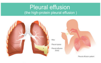 Pleural Effusion - Doctor Galaxy