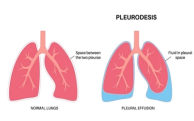 Pleurodesis - Doctor Galaxy