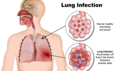 Pulmonary Infections - Doctor Galaxy